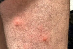 kousnutí od štěnice